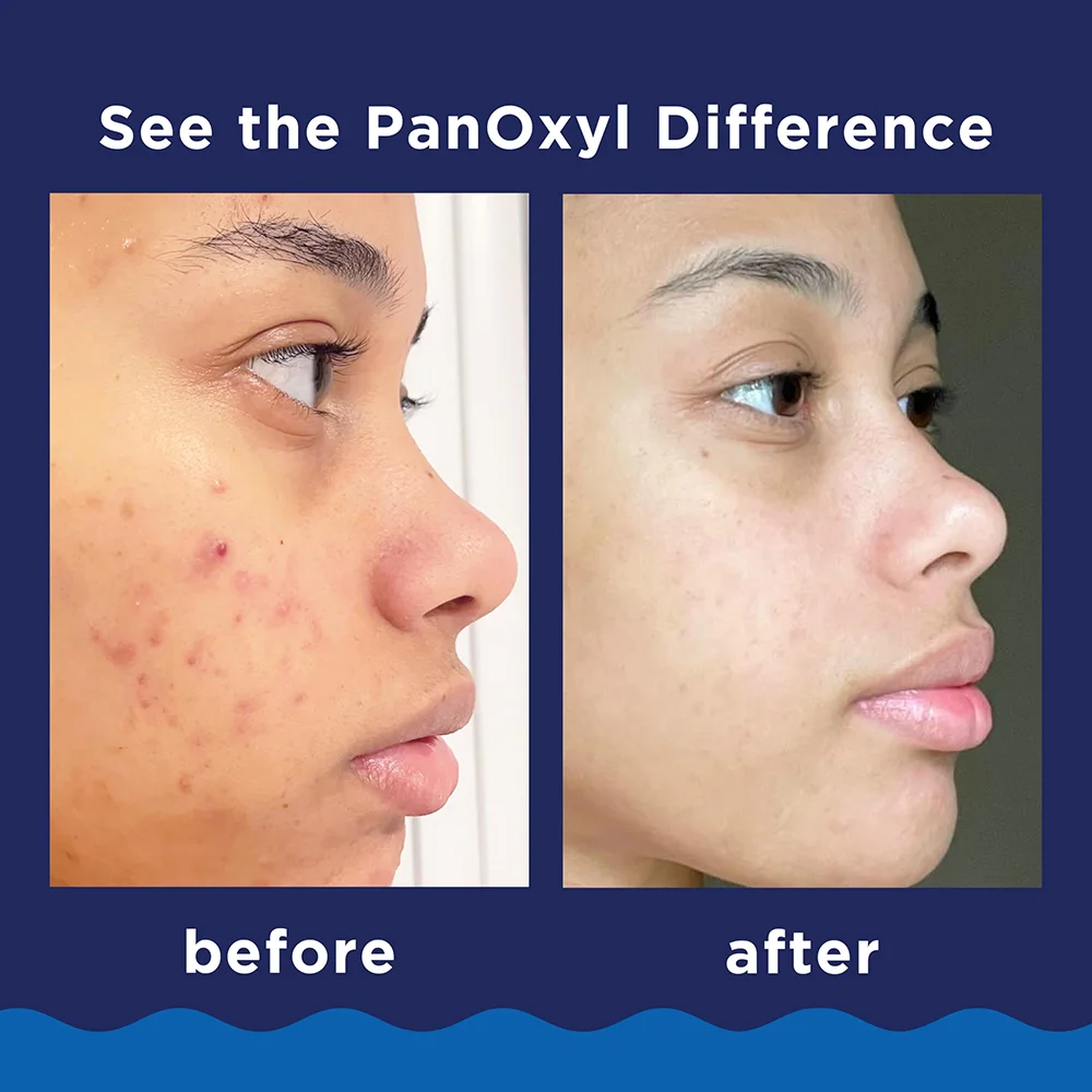 PanOxyl 10% Benzoyl Peroxide Maximum Strength Acne Foaming Face & Body Wash 4 PanOxyl 10% Benzoyl Peroxide Maximum Strength Acne Foaming Face & Body Wash - Image 4