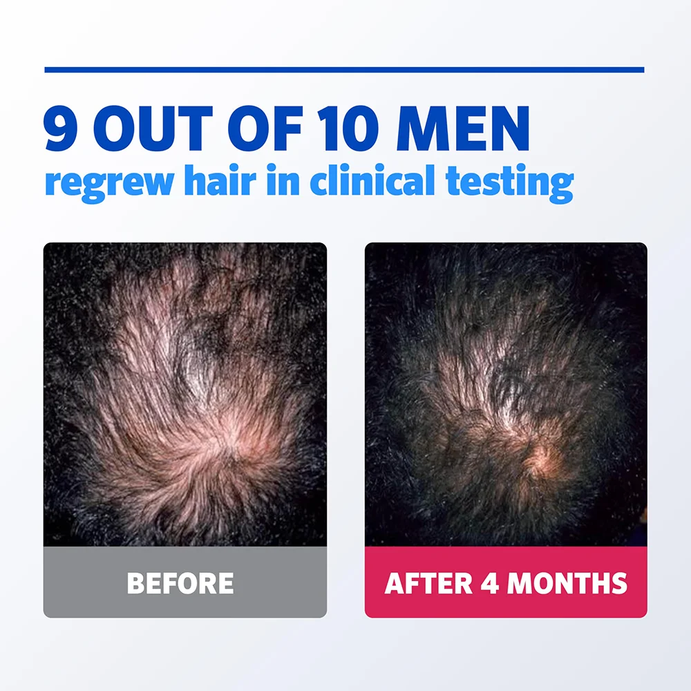 Men's Rogaine 5% Minoxidil Foam for Hair Regrowth, Clinically Proven Thinning Hair Treatment, 3-Month Supply 4 Men's Rogaine 5% Minoxidil Foam for Hair Regrowth, Clinically Proven Thinning Hair Treatment, 3-Month Supply - Image 4